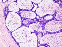 FAM, "The Breast Mouse" alias Tumor Jinak Payudara - Media Konsumen
